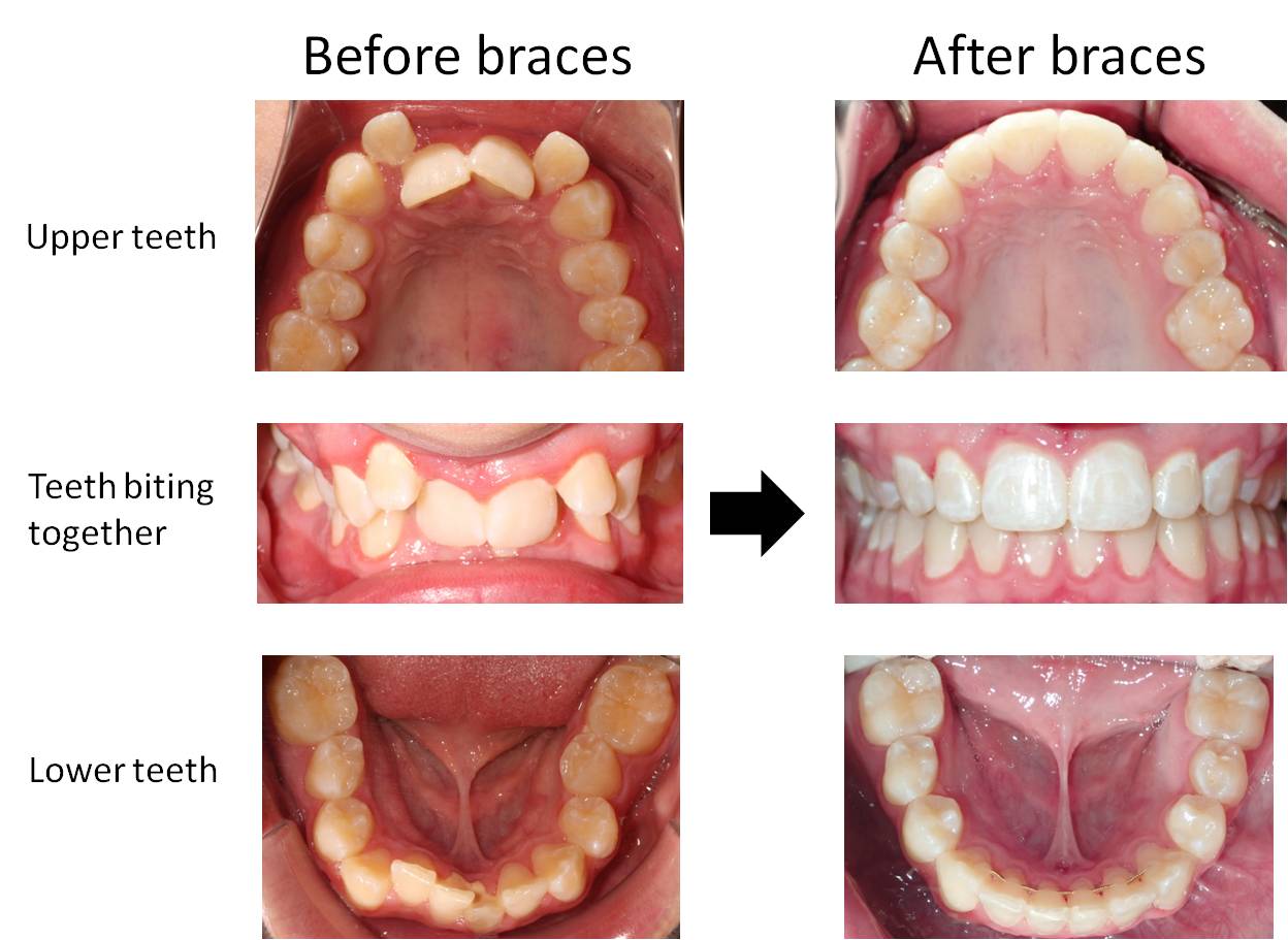 Before and after of braces