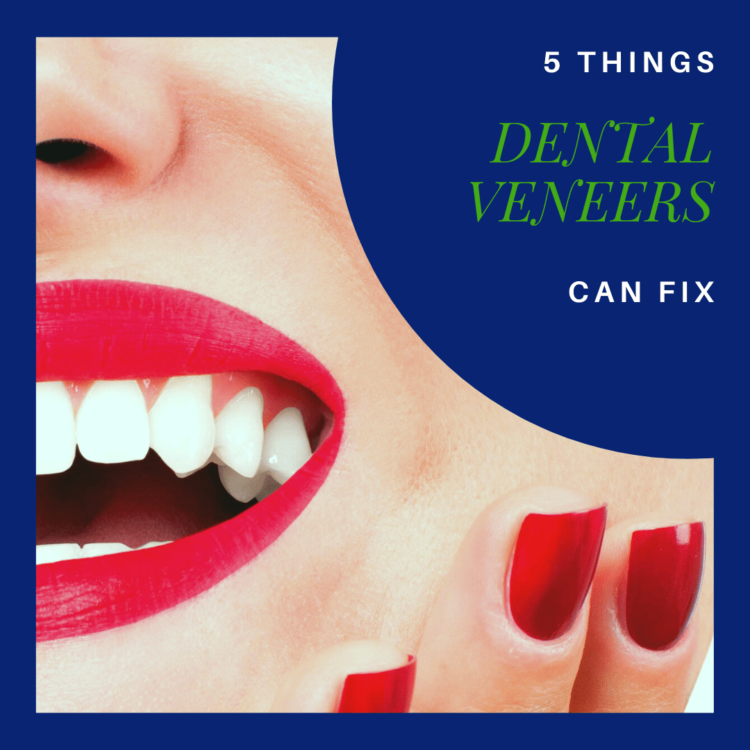 5 Things dental veneers can fix banner