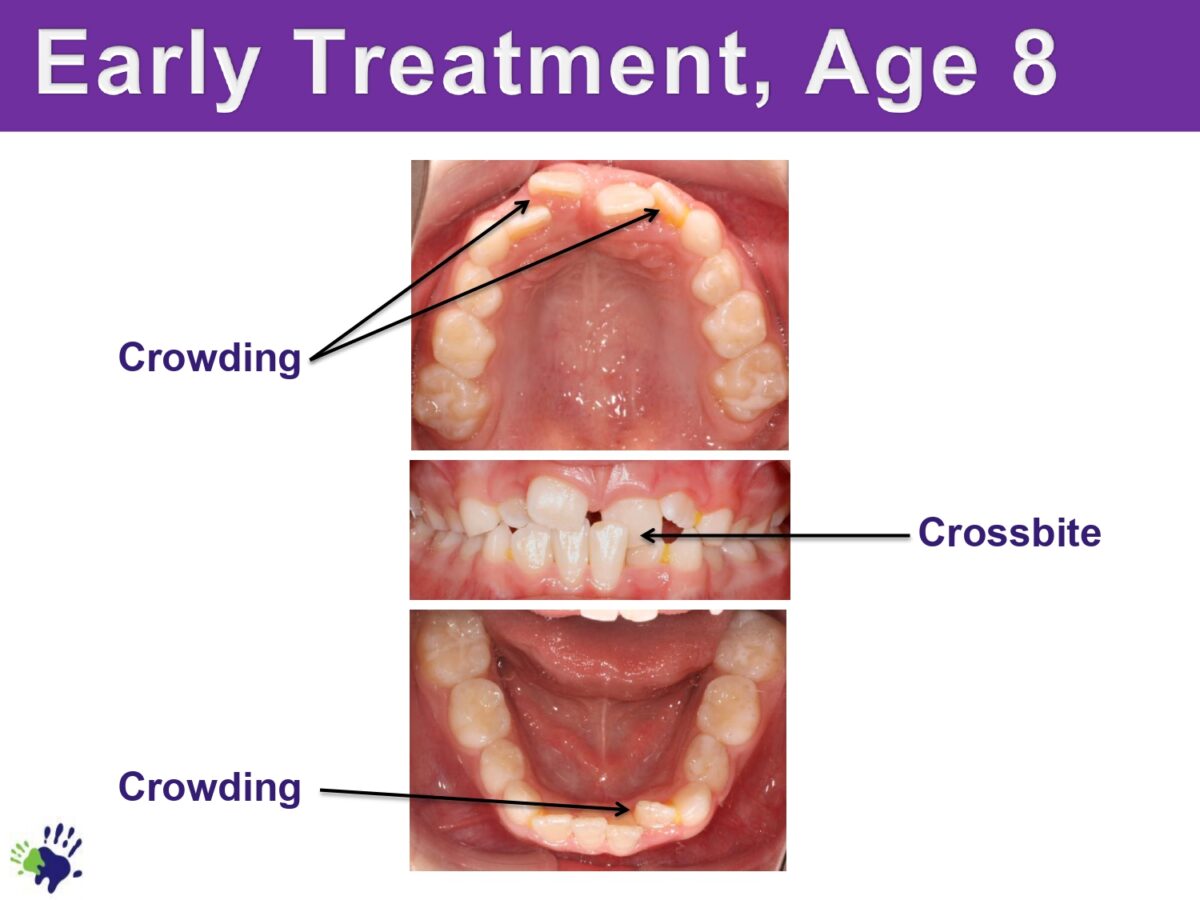 Chestnut-Dental-Before-After-Orthodontics