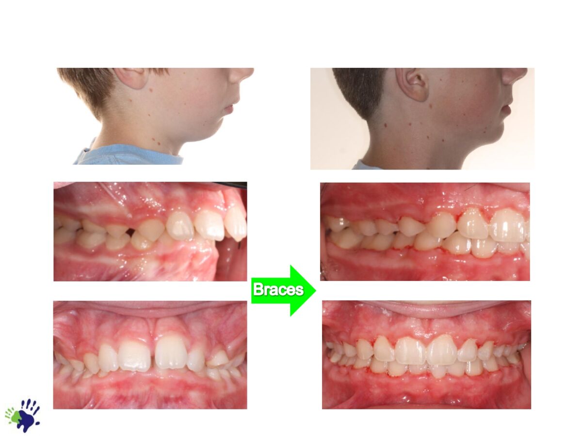 Chestnut-Dental-Before-After-Orthodontics