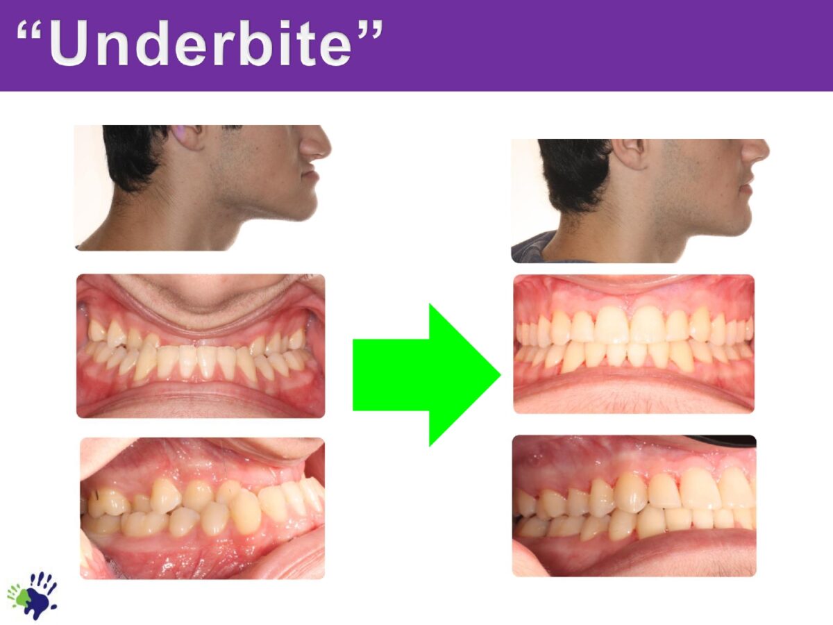 Underbite Before-After