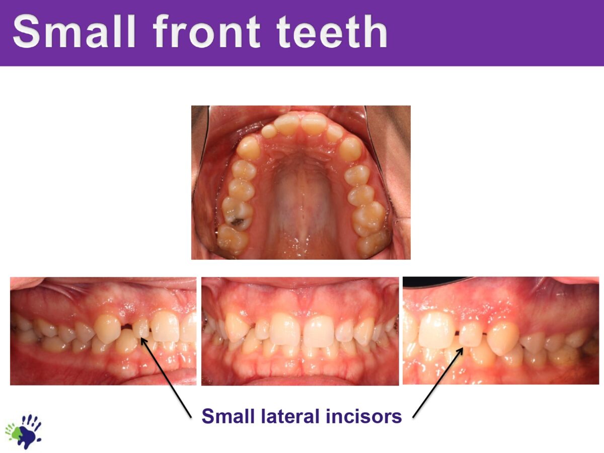 Small Front Teeth Before and After