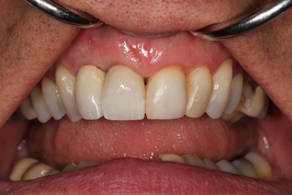 implant crown after treatment