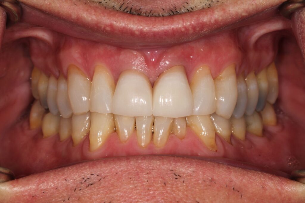WZ-crowns after treatment