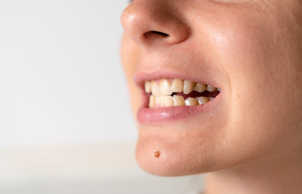 Woman with malocclusion