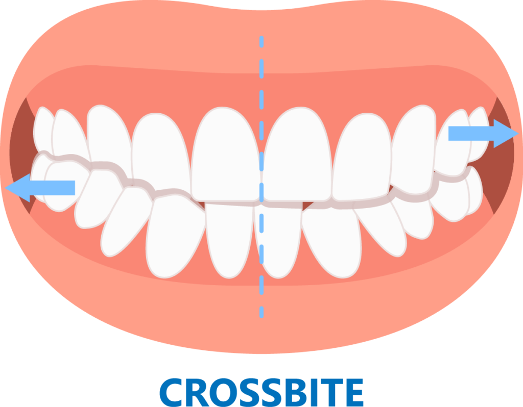 Graphic showing axis of teeth
