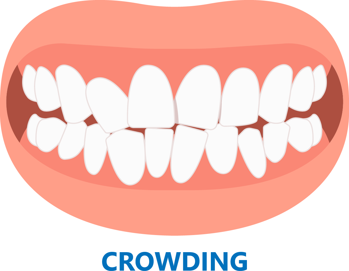 graphic of crowded teeth mouth