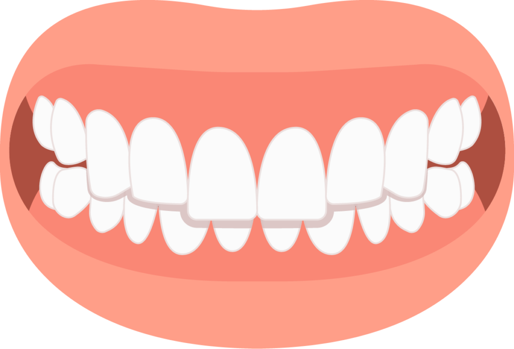 graphic of upper teeth over lower teeth