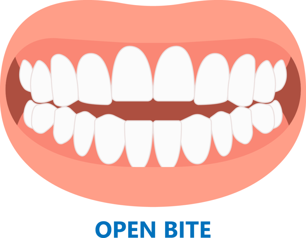 Graphic of upper and lower teeth not closing