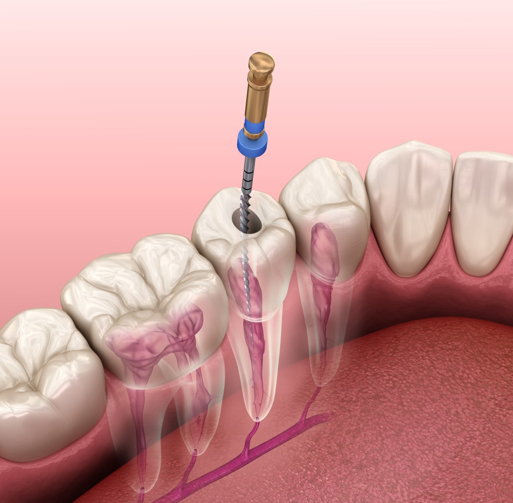 root canal file being used to remove infected tooth tissue