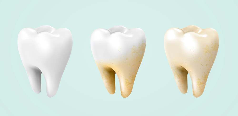 Graphic of 3 teeth with gradual yellow coloring
