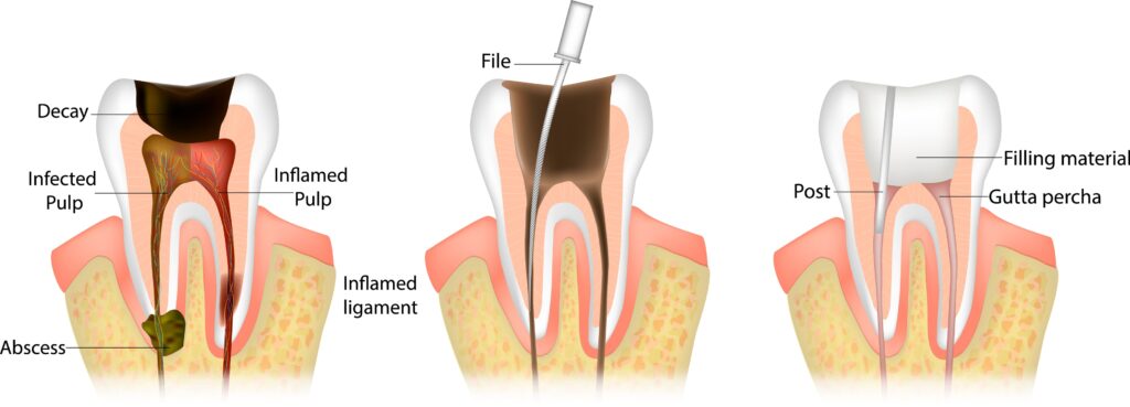 steps of root canal therapy