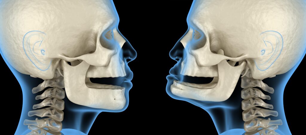 bone loss in the jaw