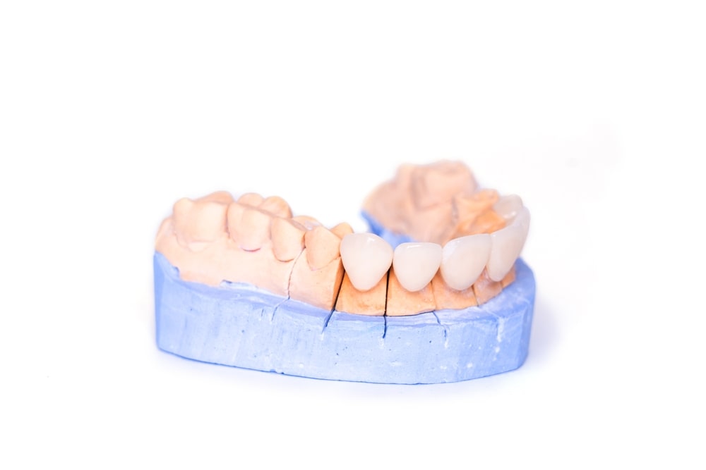 Dental bridge on teeth model
