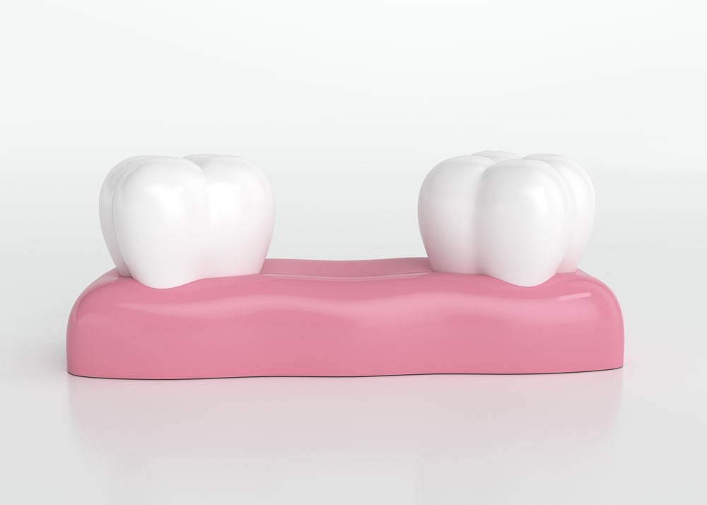 3d rendering two teeth with space between
