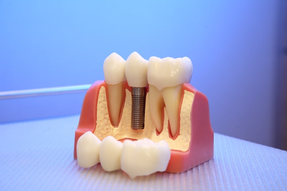 Model of tooth root and implant