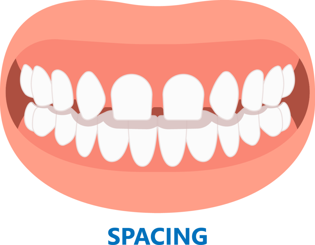 graphic of upper teeth spaced out