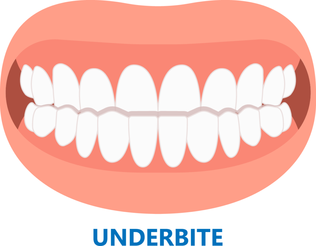 Graphic of lower teeth in front of upper