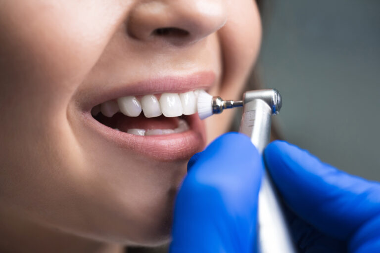 Dental Cleanings vs Teeth Whitening
