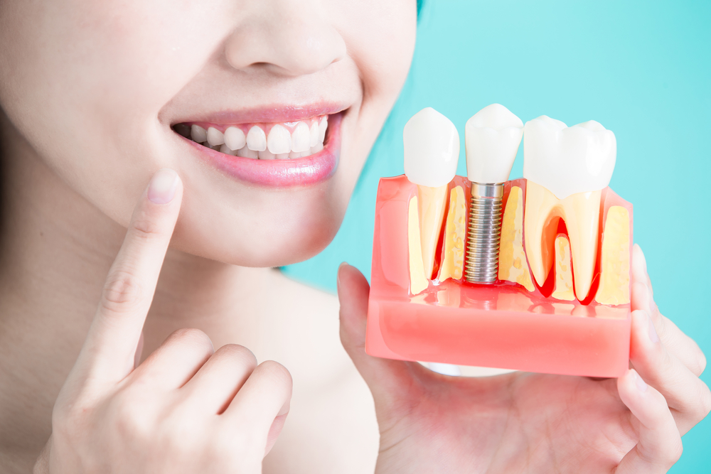 12 Fun Facts About Dental Implants