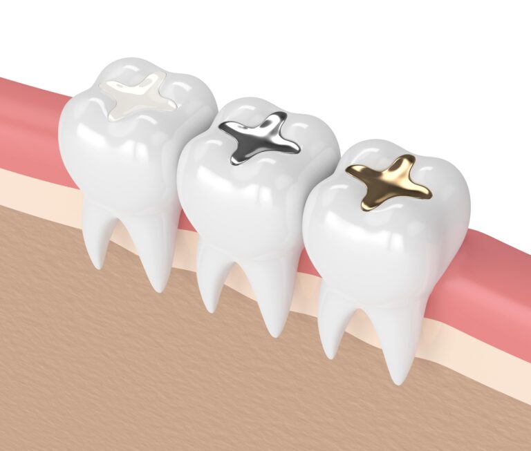 three teeth showing composite, silver, and gold fillings