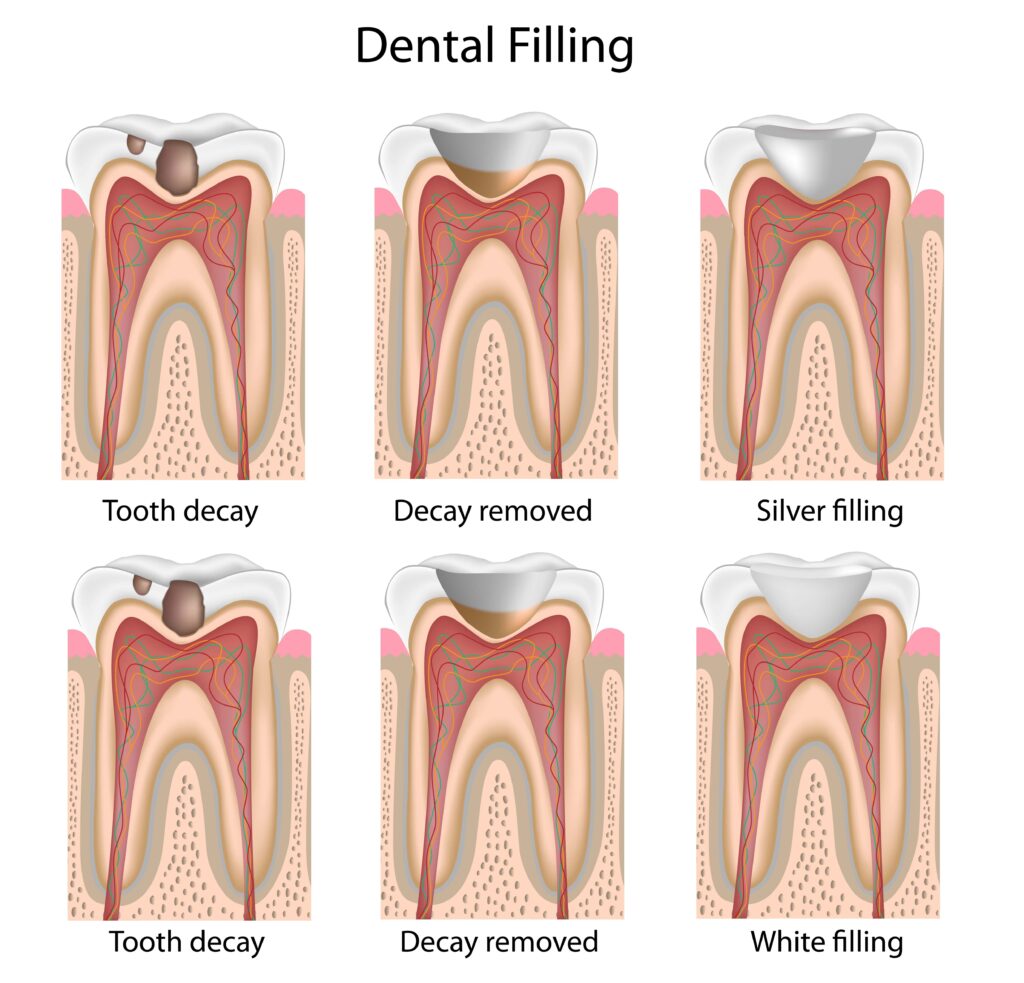 steps of a dental filling from tooth decay, decay removed, to the filling restoring the tooth
